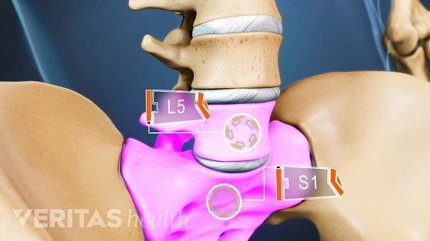 Nguyên nhân và cách điều trị thoát vị đĩa đệm cột sống thắt lưng L5-S1